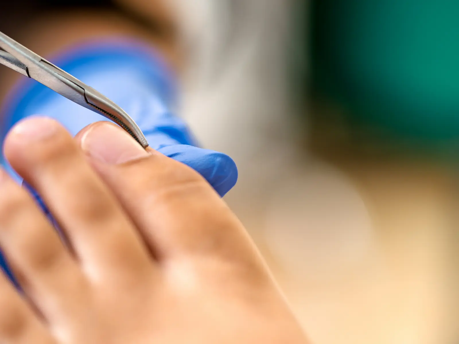 Tratamiento de uñas encarnadas en consultorio médico de Clínica La Pradera